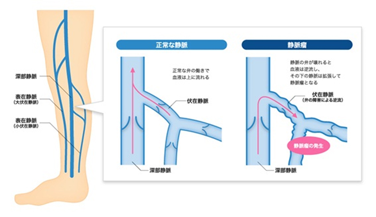 下肢静脈瘤とは？