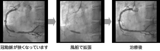 経皮的冠動脈形成術