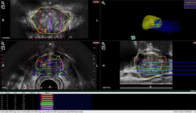 MRI画像×超音波画像の融合