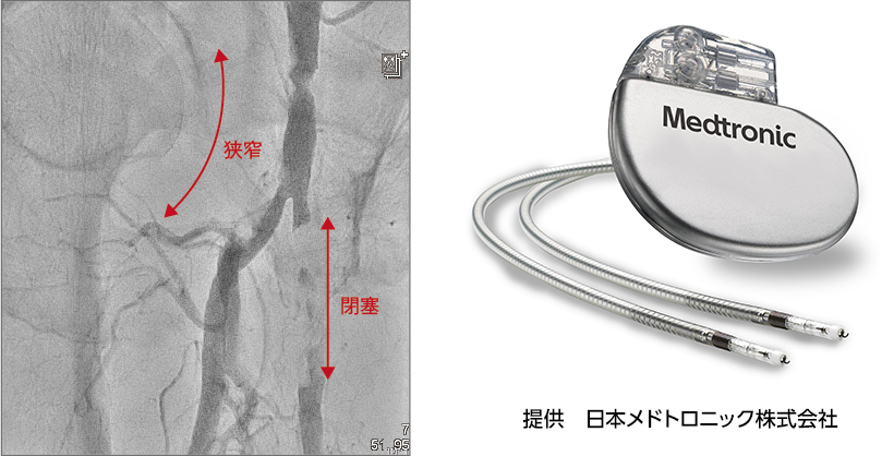 動脈硬化性病変に対する外科治療、ペースメーカー手術