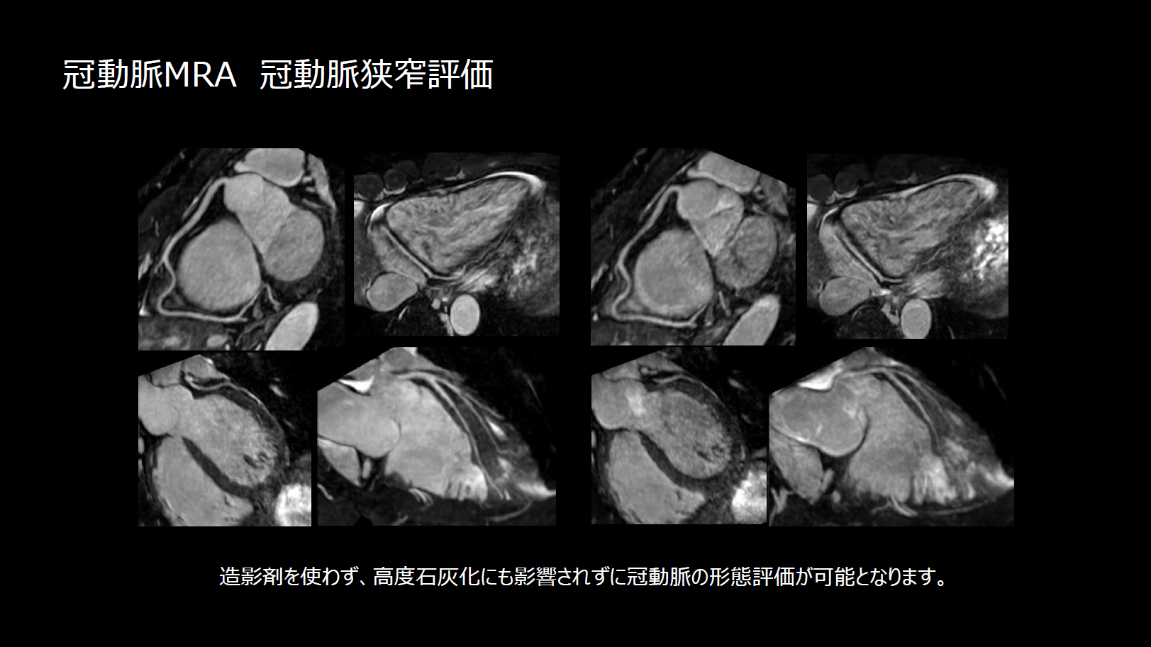 心臓CTの検査内容