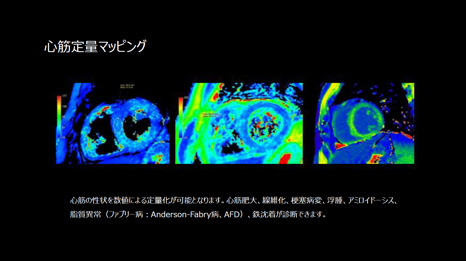 心筋定量マッピング