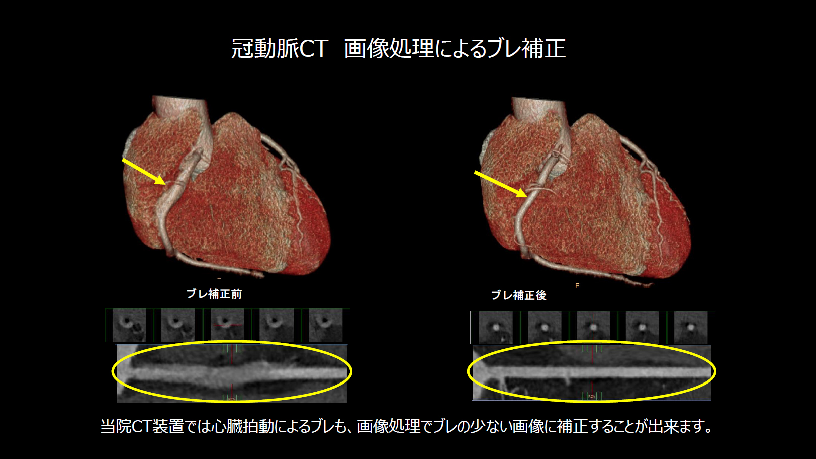 冠動脈CT 画像処理によるブレ補正