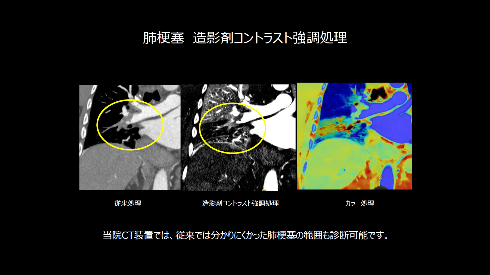 肺梗塞	　造影剤コントラスト強調処理