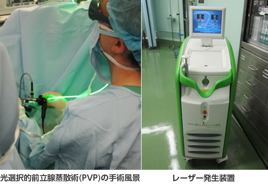 グリーンライトレーザーによる前立腺肥大症レーザー治療