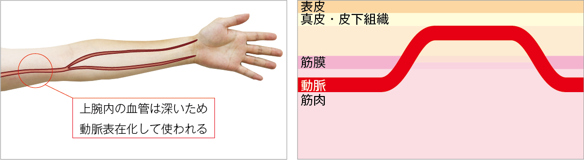 長期もしくは短期留置型透析用カテーテルによる外シャント設置
